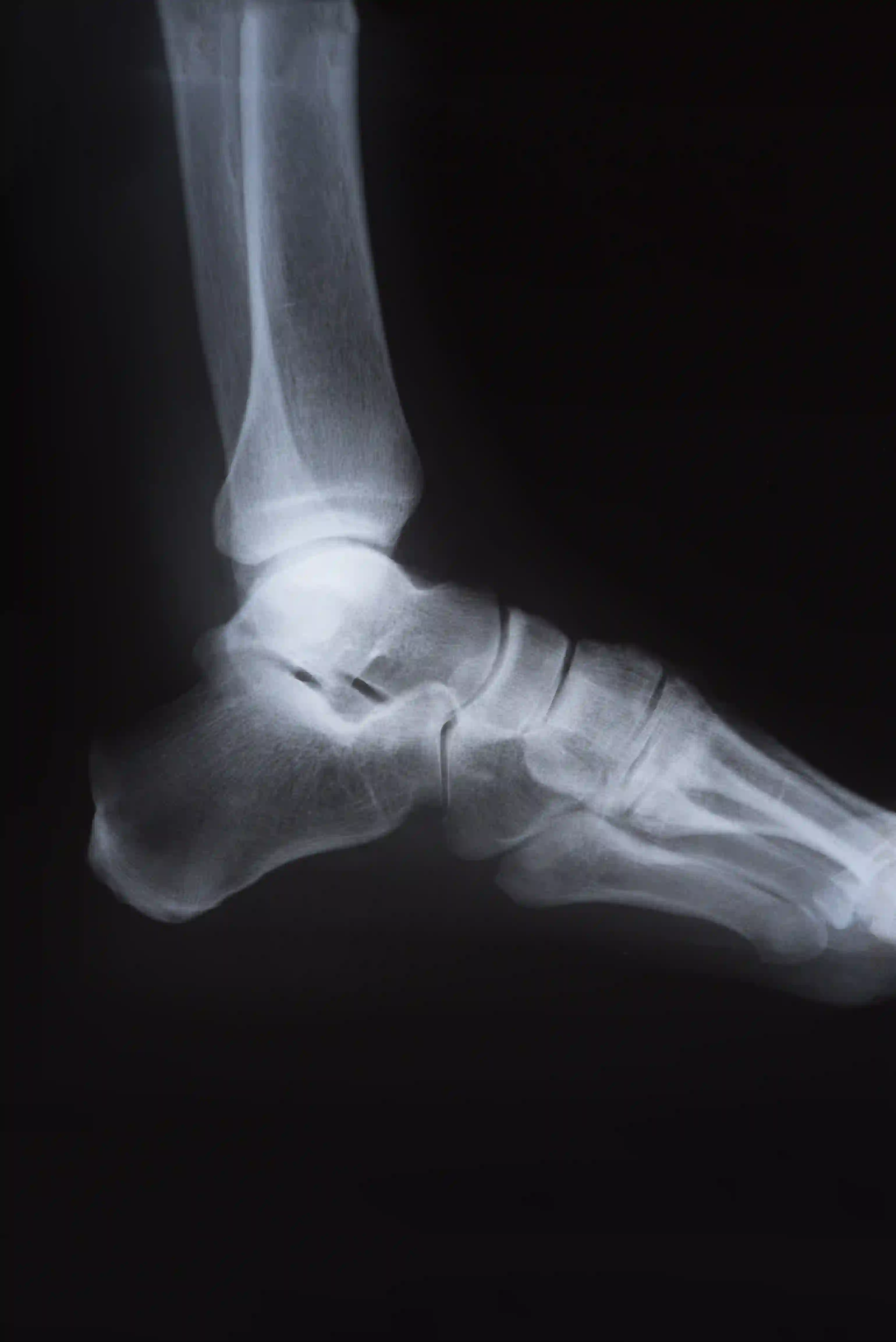 Foot & Ankle and Orthobiological Therapies
